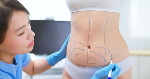 Liposuction for Defining Curves and Improving Body Proportions Liposuction for Defining Curves and Improving Body Proportions