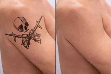 Laser Tattoo Removal for Improving the Look of Unwanted Body Art Laser Tattoo Removal for Improving the Look of Unwanted Body Art