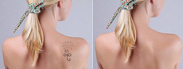 How Effective Is Laser Tattoo Removal for Stubborn Ink? How Effective Is Laser Tattoo Removal for Stubborn Ink?