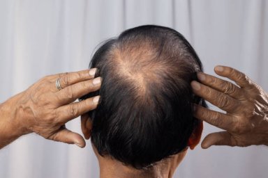 Hair Loss Treatment for Addressing Ongoing Hair Shedding Concerns Hair Loss Treatment for Addressing Ongoing Hair Shedding Concerns