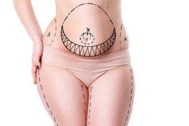 Liposuction and What to Expect Before Treatment Liposuction and What to Expect Before Treatment