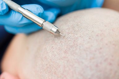 Hair Transplant in Al Ain for Concealing Small Scalp Scars Hair Transplant in Al Ain for Concealing Small Scalp Scars
